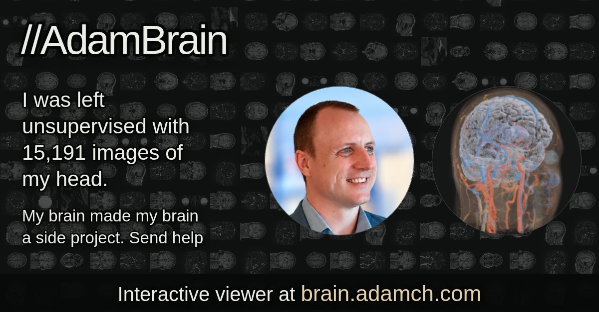 AdamBrain: Adam Chesters alongside a visualisation of his head and brain, built from 15,191 MRI images.
